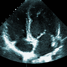 Echocardiogram (Echo)